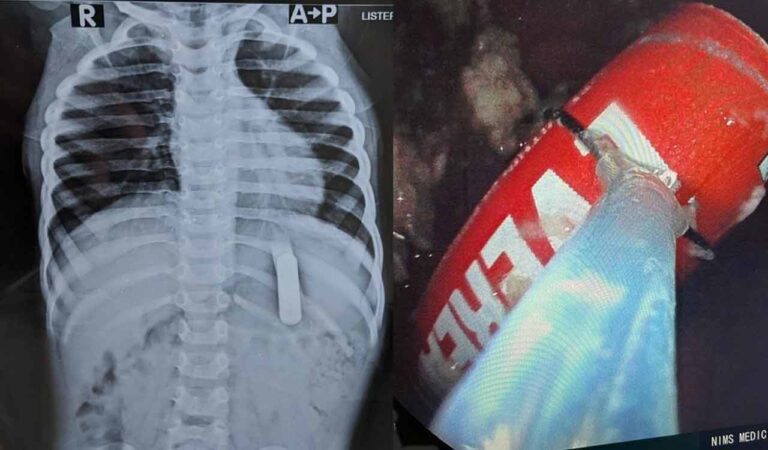 Kerala doctors save 2-year-old who swallowed TV remote batteries