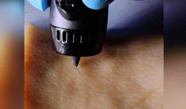 New wound-healing ink repairs wounds with a 3D printing pen